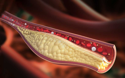 Conquering Cholesterol