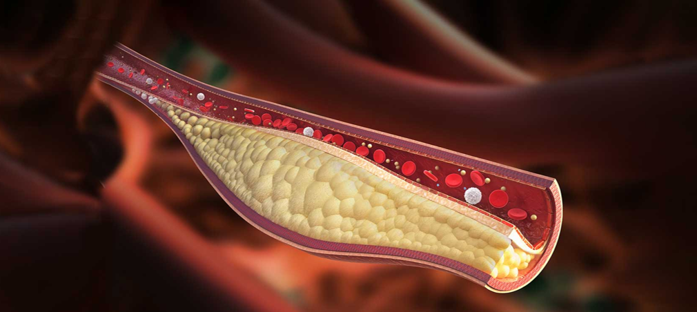 Conquering Cholesterol